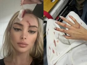 Imagens divulgadas pela Banda B mostram violência e escoriações sofridas pela modelo Alice Artigas, após ela dizer não para investida dentro de bar em Curitiba