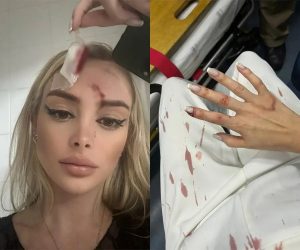 Imagens divulgadas pela Banda B mostram violência e escoriações sofridas pela modelo Alice Artigas, após ela dizer não para investida dentro de bar em Curitiba